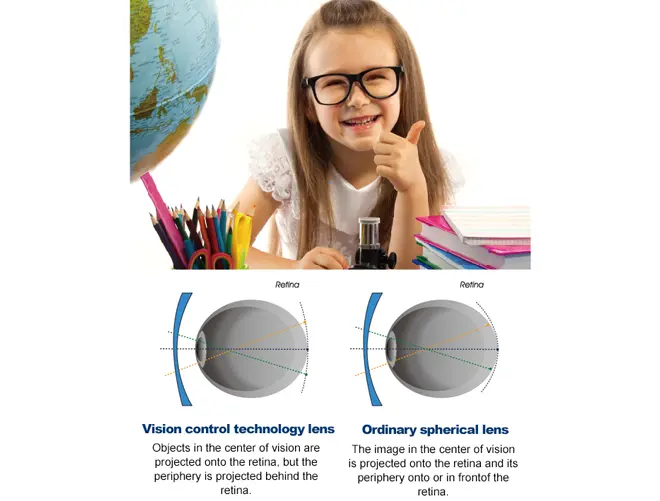 lentes de desfoco periférico myovision-defocus-kids-myopia-control-single-vision-lens-1